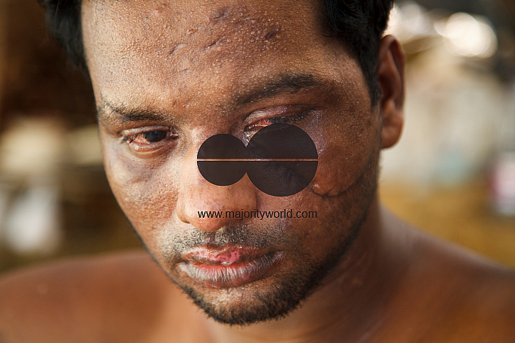 Rohingya Refugee at Tambru No-man's land in Bangladesh-Myanmar border at Tambru, Naikhyangchori, Banderban, Bangladesh